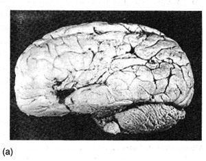 Мозг Тана (одного из пациентов Брока)